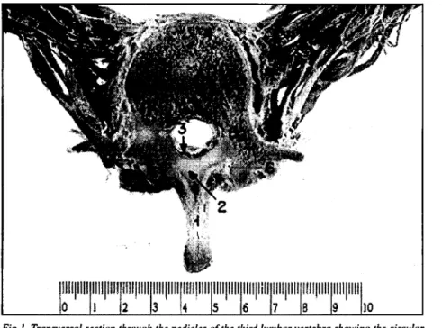 Figure 2 shows the triangular shape of the lumbar vertebral canal, the circular dural sac, the  ligamenta flava, the intervertebral foramen and both psoas muscle