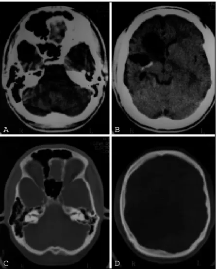 Fig 2. Case 2. Right cerebral hemiatrophy. A to D. Axial NECT scans. A. Porencephalic cyst in the right temporal fossa