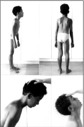 Fig 1. Photograph of the case: A. Lordosis. B. Bilateral winged scapula.