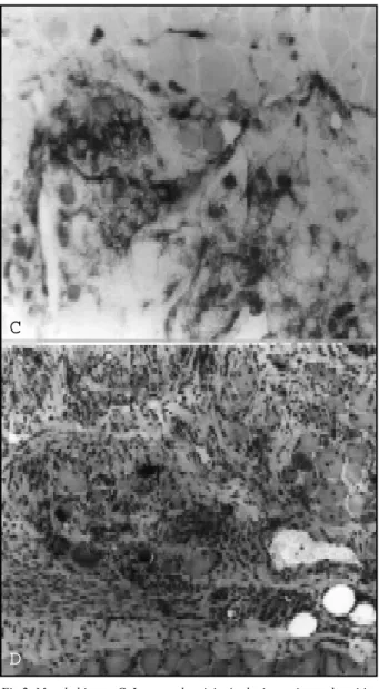 Fig 2. Muscle biopsy. C. Increased activity in the interstice and positive fibers (magnification x87; alkaline phosphatase)