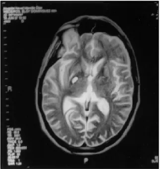 Fig 1. MRI in T2 sequence 6 months after unilateral PVP showing the size and the anatomic position of the lesion in GPI.