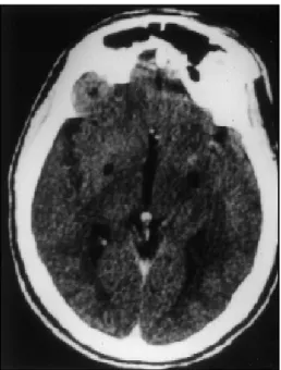 Fig 2. CT scan without contrast 6 months after bilate- bilate-ral simultaneous PVP showing the two lesions in the GPI.