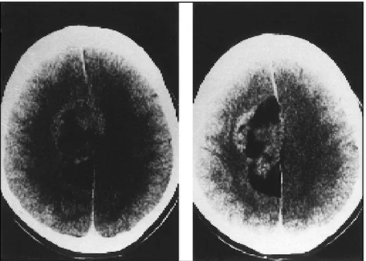 Fig 1. Unenhanced CT scans showing a parafalcine mass lesion with hyperdense and hypodense areas with attenuation coefficient of fat.
