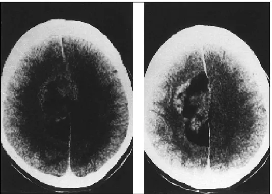 Fig 1. Unenhanced CT scans showing a parafalcine mass lesion with hyperdense and hypodense areas with attenuation coefficient of fat.