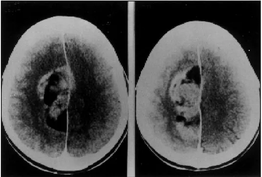 Fig 2. Contrast enhanced CT scan showing the same lesion of Figure 1 with enhancement in the former hyperdense areas.