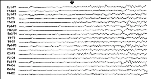 Fig 1. Initial left hemisphere irregular slow waves in a left temporal seizure (arrow)