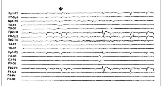 Fig 2. Right temporal rhythmic theta waves during a right temporal seizure (arrow). 100 µV/mm.