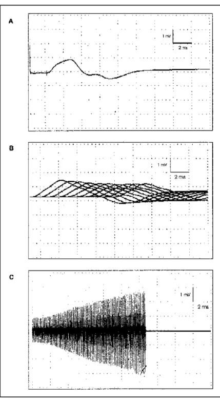 Fig 1. Case 1. (A) CMAP on ulnar motor nerve collected from the 5th digit abductor muscle showing amplitude of 1.6 mV