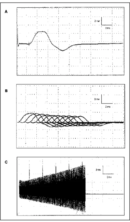 Fig 2. Case 2. (A) CMAP on ulnar motor nerve collected from the 5th digit abductor muscle showing amplitude 4.1 mV