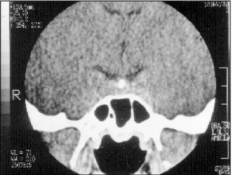 Fig 1. CT scan of the sellar region showing calcification of the pituitary stalk.