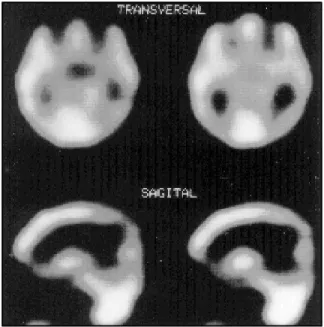 Fig 3. SPECT of patient 10 shows hypoperfusion of frontal and parietal regions.