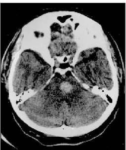 Fig 1. CT scan showing a hematoma located in the left pontine tegmentum.
