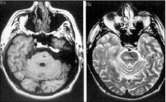 Fig 2. MRI of head showing in T1 a negative signal which was indicative of hemosiderin or calcification