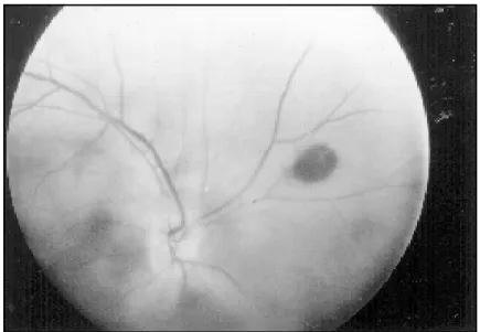 Fig 1. Right eye fundoscopy showing pigment change of peripheral retina, retinal hemorrhage and vitreous hemorrhage.