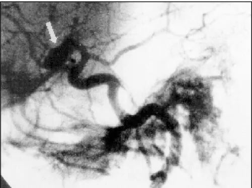 Fig 3. Cerebral angiography showing aneurysm of the right middle cerebral artery (arrow).