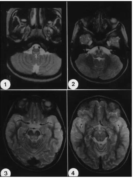 Figs 1-4. MRI T2- weighted (2500 TR/ 90 TE) transversal images of 6 mm of thickness, exam performed with 4 years of evolution (5 year-old)