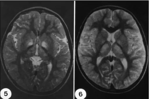 Figs 5-6. MRI T2- weighted (2500 TR/ 90 TE) transversal images of 6 mm of thickness, exam performed with 4 years of evolution (5 year-old): show a symmetrical T2 hypersignal on pallidum and thalamus, sparing the internal capsule.