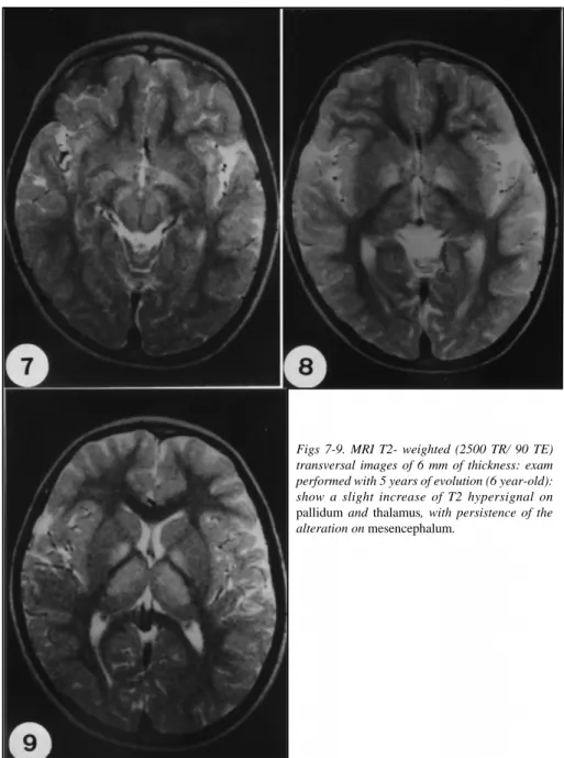 Figs 7-9. MRI T2- weighted (2500 TR/ 90 TE) transversal images of 6 mm of thickness: exam performed with 5 years of evolution (6 year-old):