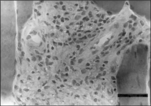 Fig 2. Inflammatory infiltrate in the perimysium with mononuclear cells. Haematoxylin &amp; Eosin