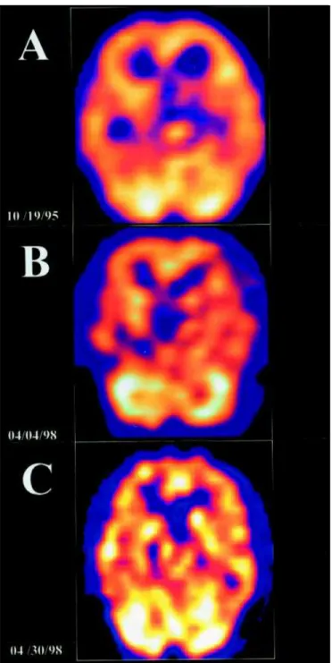 Fig 1. Brain SPECT imaging with  99m Tc-HMPAO in a patient with Huntington’s disease and severe choreiform movements