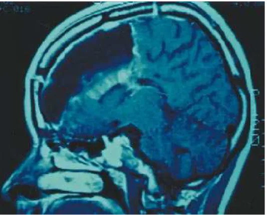 Fig 5. Immediate post-operative MRI showing the extent of frontal resection.