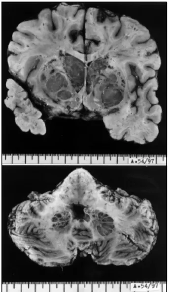 Fig 2 (Above). Coronal section through the cerebral hemispheres showing various cavities filled with gelatinous material replacing most of the basal ganglia and compressing the lateral ventricles