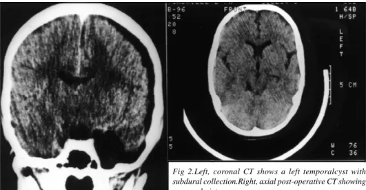 Fig 2.Left, coronal CT shows a left temporalcyst with subdural collection.Right, axial post-operative CT showing a normal picture.
