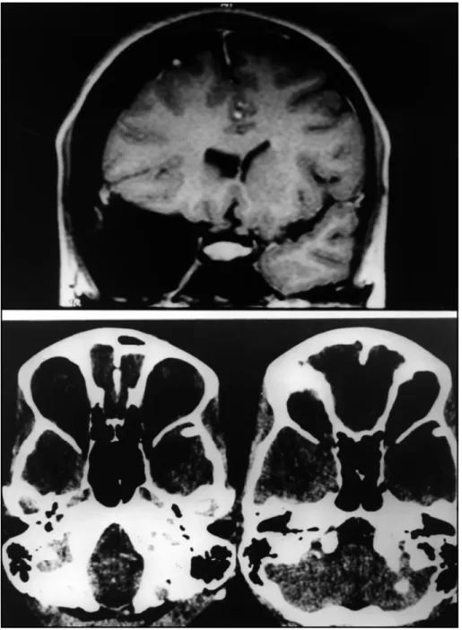 Fig 4 Above. A, coronal T1- weighted MRI shows a large left temporal cyst with subdural collection