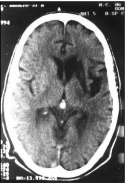 Fig 3. Angiography showing proximal occlusion of the left internal carotid artery (Left) and a large network of collateral vessels (Right).