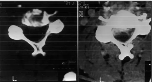 Fig 1. Preoperative venous contrast administration cervical CT scan. A (left) - Showing destruction of the C4 vertebral body