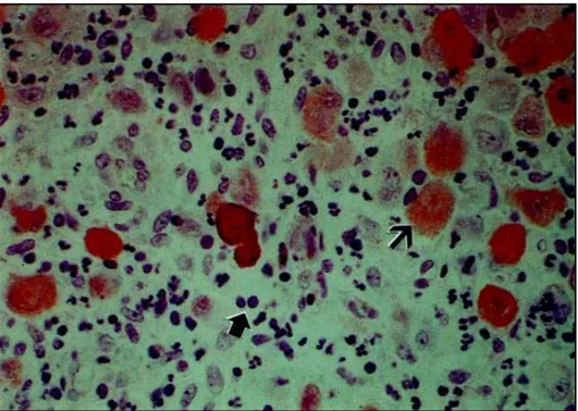 Fig 3. Histopathological study. Prepared antibody protein anti S-100 disclosed infiltrate composed of Langerhans’