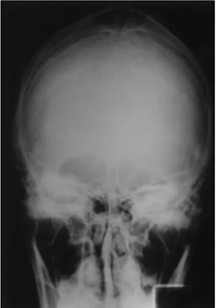Fig 2. Patient’s MRI; A: coronal T2-weighted section shows a biparietal lytic lesion without dural invasion ; B: