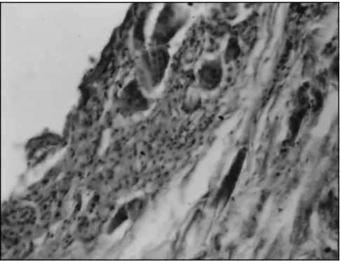 Fig 3. Wall of ruptured pilonidal cyst with foreign body giant cells ( 25 x ).