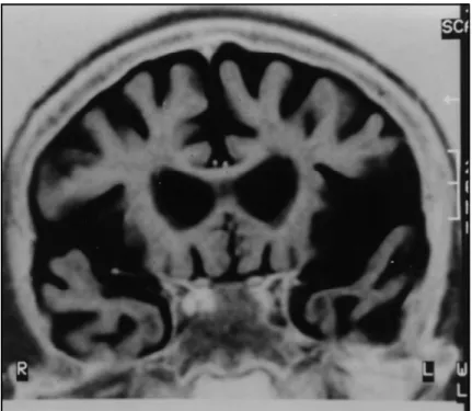 Fig 1. MRI coronal image showing bilateral frontal and temporal lobes atrophy, mainly on the left temporal lobe.