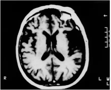 Fig 2. MRI transaxial image showing bilateral frontal and temporal lobes atrophy, mainly on the left temporal lobe