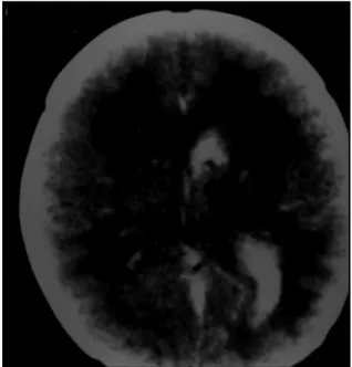 Fig 2. Case 2. CT scan on day 8 of life showing low and hyperdensity areas.
