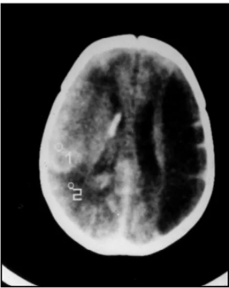 Fig 4. Case 4. CT scan on day 5 of life showing left fronto-parietal haemorrhage.