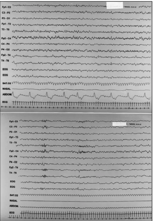 Fig 3. Polysomnography performed at 7 months, (a) with ventilatory support CPAP, (b) when the ventilatory support is disconnected