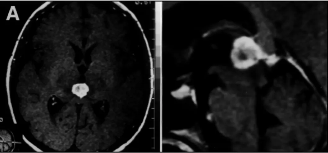 Fig 1. MRI T1-weighted axial (A) and sagital views after gadolinium injection showing hyperintense lesion compressing mesencephalon and quadrigeminal plate.