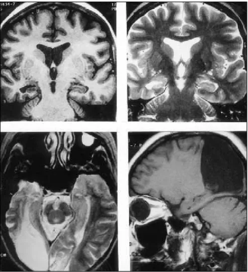 Fig 2. Patient 6. Thirty-eight-year-old woman with intractable seizures since the age of 10