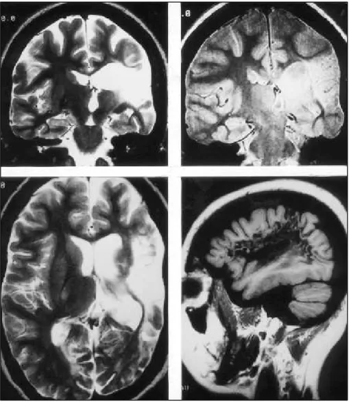 Fig 3. Patient 17. Twenty-year-old girl with intractable partial seizures of left temporal lobe origin