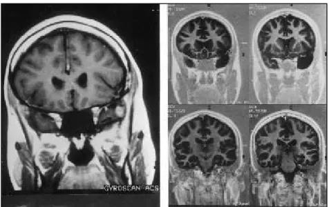 Fig 1. A polar left temporal lobe lesion. Pre (A) and postoperative(B) aspects. The mesial temporal structures are preserved (pleomorphic xanthoastrocytoma).