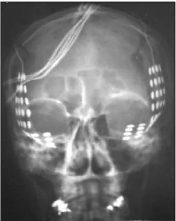 Fig 1. Skull X-ray showing the typical position of the bilaterally implanted subdural grids.