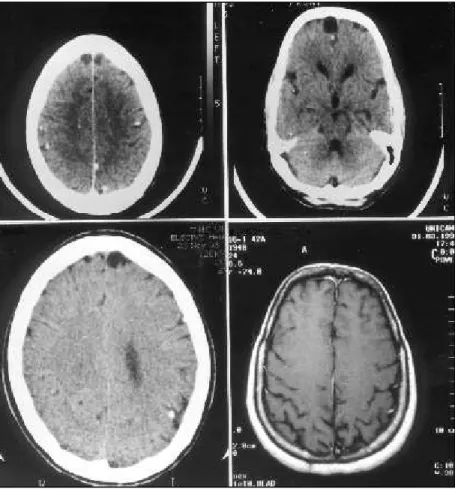 Fig 1. Persistence of frontal cysts in CT series taken over a period of 77 months and cyst resolution after cysticidal therapy: 1A: CT of the cranium performed in June, 1992, showed frontal cystic lesions and multiple calcifications