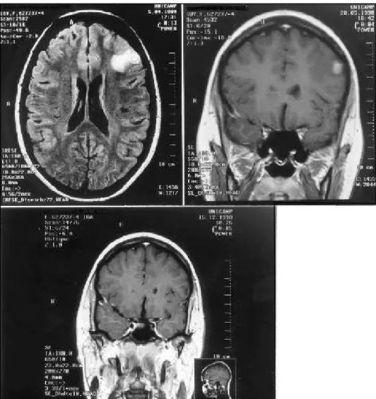 Fig 2. Cyst resolution in a patient who was immediately put on cysticidal therapy: 2A: MRI performed in April, 1998, showed a cystic lesion in the left frontal region, the patient was immediately put on cysticidal therapy