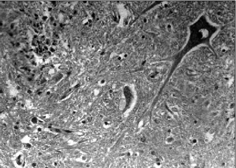 Fig 1. Spinal cord-tissue specimen at level of gray matter showing a microglial nodule (hematoxylin and eosin, x200).
