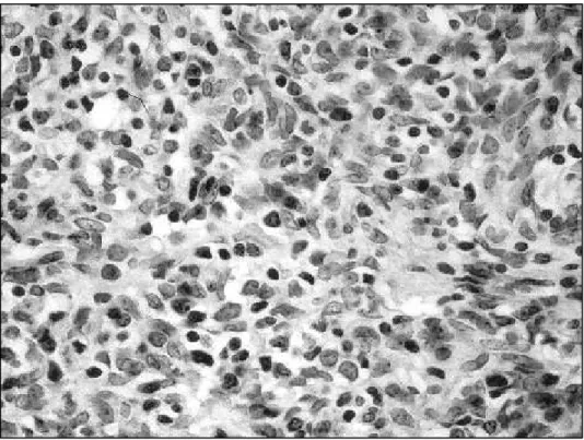 Fig 1. Photomicrography of medullary thymoma composed of spindle epithelial cells admixed with mature lymphocytes (HE).