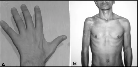 Fig 1. A. Case 11 - Amyotrophy of left hand . B. Case 6 - Wasting of muscles of proximal right limb.