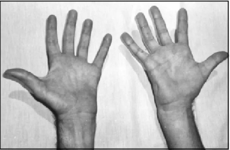 Table 2. Abnormal finding in the needle electromyography in the four limbs.