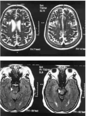 Fig 1. MRI (brain and brainstem, case 1). Brain MRI - flair and T2 - weighted showing (white arrows) ischemic areas in semi-oval center (lacunae), cerebral peduncles/brainstem.